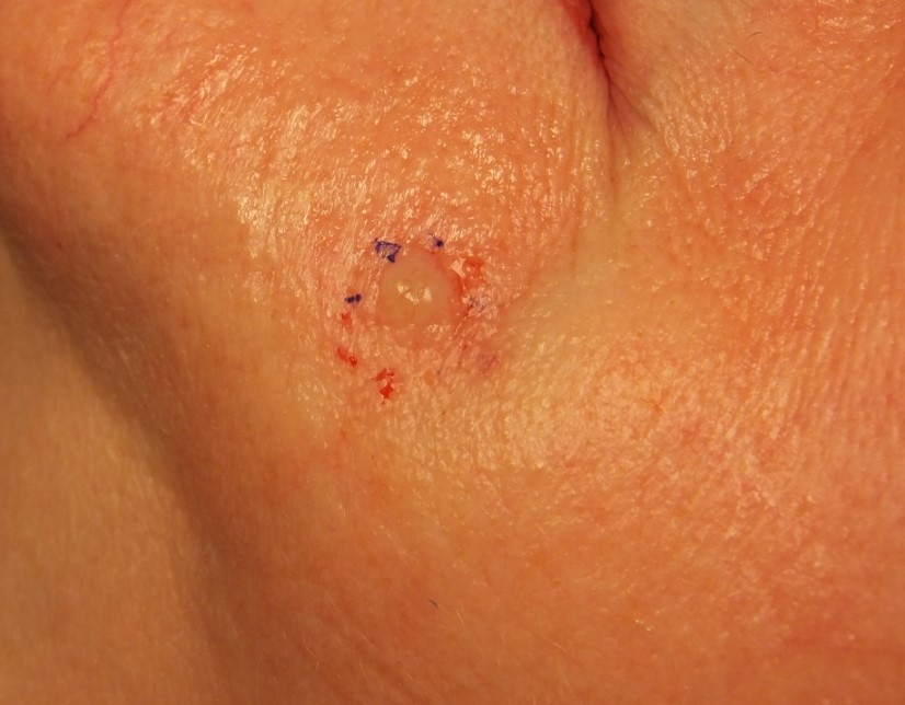 Figure 4 A, Infiltrating and micronodular basal cell carcinoma (BCC)